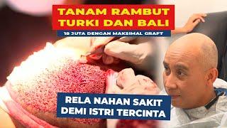 TANAM RAMBUT TURKI HADIR DI BALI  Tonton sampai habis penanganan terbaik