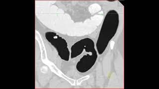 Virtual colonoscopy with polyp in sigmoid colon