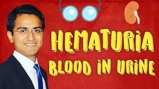 Hematuria Causes & Diagnostic Workup of Blood in Urine
