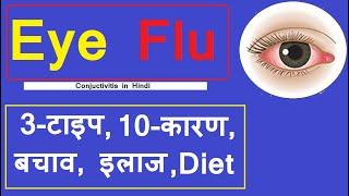 Eye flu information  Eye flu major types symptoms causes domestic treatment in child & adults