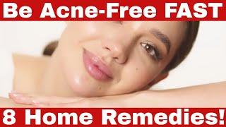 Home Remedies for Acne You Must Try – Choose The Best Acne Home Remedy For You