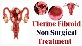 Treating Uterine Fibroid without Surgery  Embolization  #uterinefibroidtreatment #fibroidsurgery