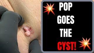 POP GOES THE CYST