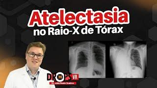 ATELECTASIA - APRENDA A RECONHECER NO RAIO-X DE TÓRAX I VOCÊ RADIOLOGISTA