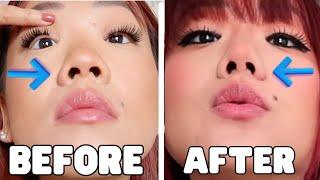 Nose Job Update  Rhinoplasty + Alarplasty  3 yrs post-op rhinoplasty  1.5 yr post-op alarplasty