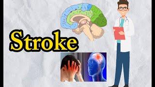 What is Stroke  Signs and types