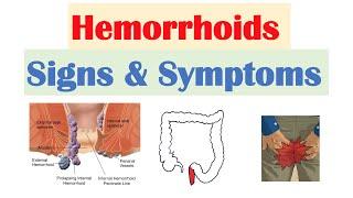 Hemorrhoids Signs & Symptoms  Internal vs. External Hemorrhoid Symptoms  Hemorrhoidal Disease