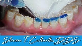 Bonding Worn Anterior Teeth - Dental Minute with Dr  Steven T. Cutbirth DDS