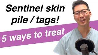 5 ways to deal with Sentinel Skin TagPiles