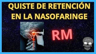 QUISTE DE RETENCIÓN del espacio MUCOSO FARÍNGEO  Resonancia Magnética