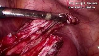 Ovarian Cystectomy by Dr.Avijit Basak Chocolate Cyst Laparoscopic Cystectomy Ovarian Cyst