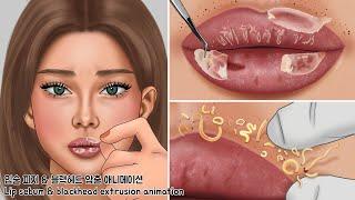 ASMR sebaceous mass explosion Lip Blackhead Extrusion  Taking care of dead skin cells on your lips