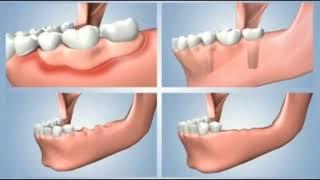 Dental implants or Dental dentures for missing teeth? @GoldenSmileDent