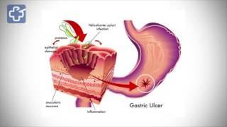 Nguyên nhân đau dạ dày - Nguyên nhân viêm dạ dày - Nguyên nhân loét dạ dày