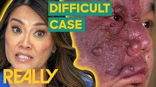 Dr. Lee Calls For Backup To Tackle An Extreme Case  Dr. Pimple Popper