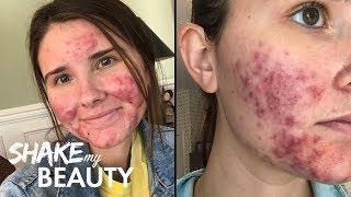 Going Out With My Severe Acne For The First Time  SHAKE MY BEAUTY