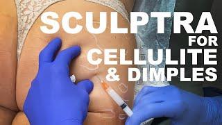Sculptra for Cellulite and Dimples- Dr. Paul Ruff  West End Plastic Surgery