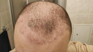 2 Hair Transplants - 2 Months Update   SHOCK LOSS 