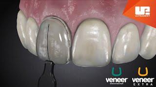 Uveneer® Procedure Animation  Direct Veneer Template System