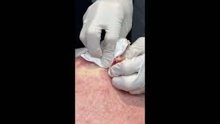 Magnificent Cyst Pop  #PimplePopper #pimplepopping #cystpoping #skinhealth