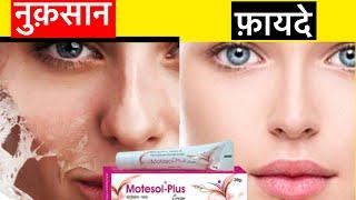 Motesol plus cream  Motesol plus cream ke fayde nuksan  Motesol plus cream side effects