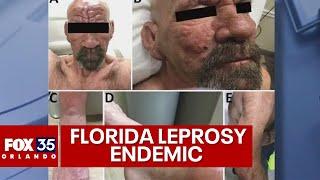 Leprosy endemic in Central Florida CDC warns