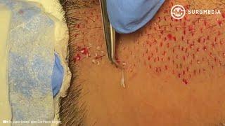 Step by Step Neograft Hair Transplant Procedure