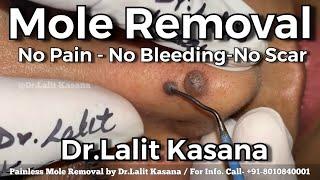 Painless Mole Removal in Seconds by Dr.Lalit Kasana