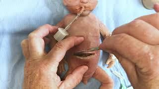 Repairing Baby Patrick - MEDICFX