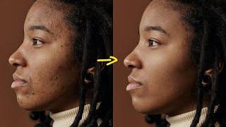 How to Quickly REMOVE PIMPLES & Blemishes in Photoshop  Photo Editing Tutorial