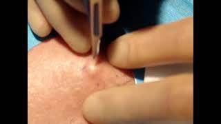 Skin surgery - epidermoid sebaceous cyst removal 1