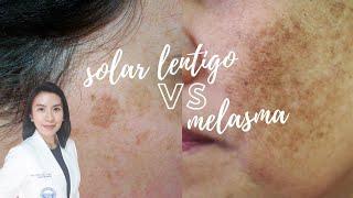 Whats the difference Solar Lentigo vs Melasma?