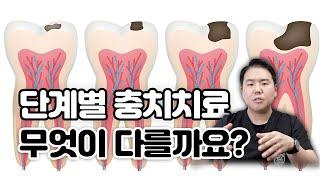 다같은 치료가 아니다 단계에 따른 충치 치료를 알려드립니다