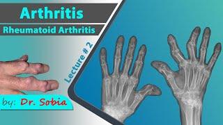 Arthritis lecture 2  Rheumatoid Arthritis  Dr.Sobia