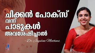 Measles  chicken pox  marks removal  ചിക്കൻ പോക്സ്  പാടുകൾ മാറ്റാൻ  Dr Jaquline Mathews BAMS