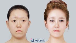 Let Me In Korea Plastic Surgery   Facial Bone Surgery Forehead Augmentation