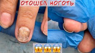 Онихолизис зачистка ногтя  Отошел ноготь от ногтевого ложа