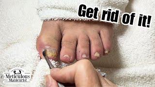 How to Get Rid of Yellow Toenails #nails #satisfying