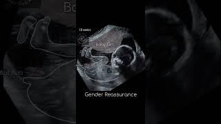 Ultrasound report Baby Boy or Girl? 12 weeks Gender Reveal  #shorts