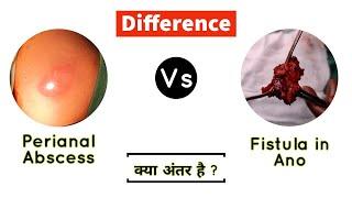 PERIANAL ABSCESS vs FISTULA IN ANO - Difference
