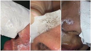 Extremely satisfying nose pore strips peel for blackheads and pimples TikTok compilation  pt. 2 