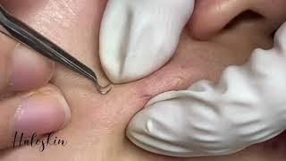 Halo Skin Hong Kong 暗粒療程 Acne and Blackheads around the mouth #Shorts