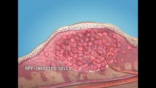 What are warts HPV? - 3D animation