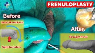 Short frenulum  Treatment  Tight foreskin  Frenuloplasty