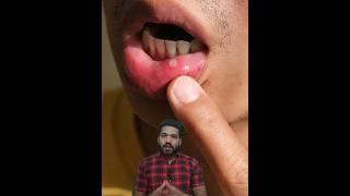 4 Home remedies for mouth ulcers मुँह के छाले घर पर ठीक करें #shorts