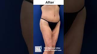 Skin Removal after Weight Loss #shorts