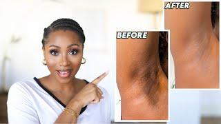 HOW I GOT RID OF MY DARK UNDERARMS  HOW TO BRIGHTEN YOUR ARMPITS + KEEP THEM EVEN & SMOOTH