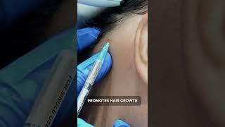 Discover the Magic of PRP Treatment for Hair Loss #prp #haircare #hairloss #hairgrowth