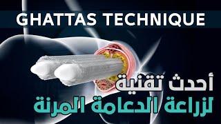 أحدث تقنية لزراعة الدعامة المرنة - Ghattas Technique