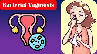 Bacterial Vaginosis - Causes Risk Factors Signs & Symptoms Diagnosis And Treatment